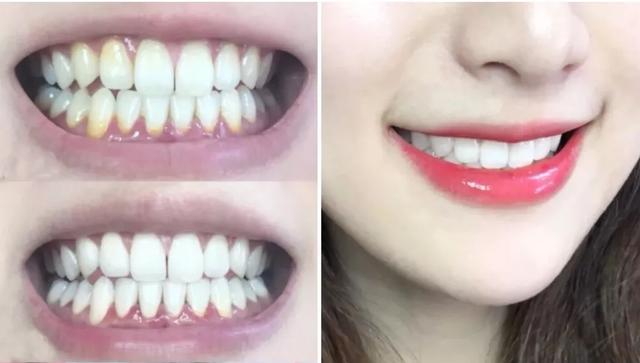 刷牙怎么刷能立刻从黄牙变成白牙,刷牙白牙小妙招