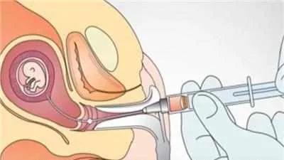 临沂哪个医院可以做羊水穿刺,临沂妇幼保健院羊膜腔穿刺