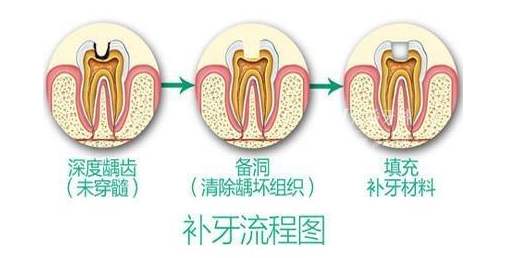 补牙为什么要把牙缝补大一点,补牙为什么要先磨大牙洞