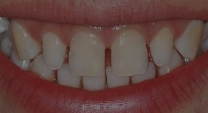 18岁女孩牙齿磨了,门牙是烤瓷牙可以矫正牙齿吗