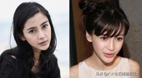 广东中医院自体脂肪填充后缩下巴,下巴自体脂肪填充需要多久