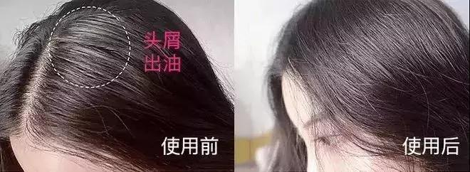 头发毛躁并且脱发推荐洗发水,用什么洗发水改善头皮脱发