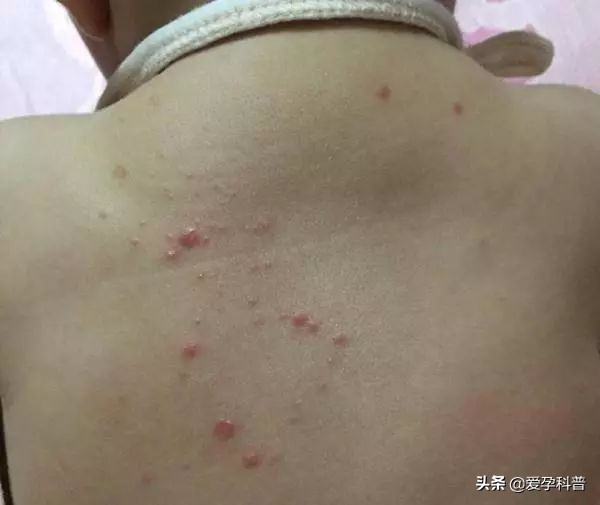 宝宝长湿疹是因为“胎毒”？家长若不做这4件事，湿疹就难治了