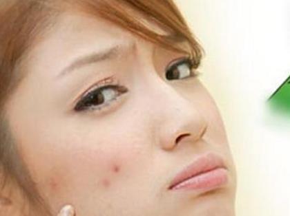 脸上的痘痘和粉刺的区别,女性常见的几种类型痘痘