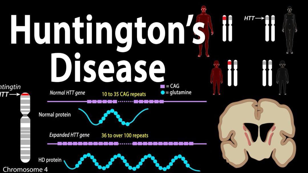 亨廷顿氏舞蹈症诊断方法,亨廷顿氏舞蹈症最新研究成果