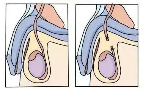 女人结扎后有什么影响,结扎对男人影响大还是女人影响大