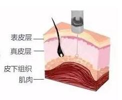 瘦脸针怎么避开腮腺,瘦脸针僵硬感怎么解决