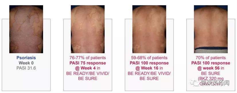 目前治疗银屑病最好的生物制剂,全球最新银屑病新药