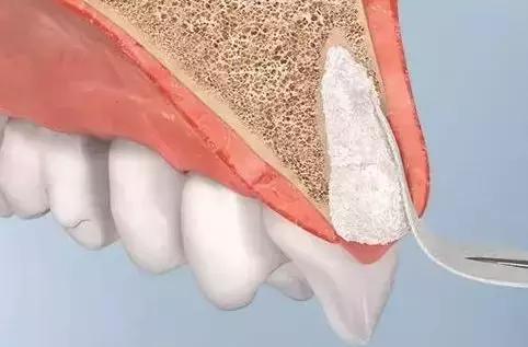 拔完牙窟窿里有食物残渣,拔完牙的窟窿进食物了怎么办