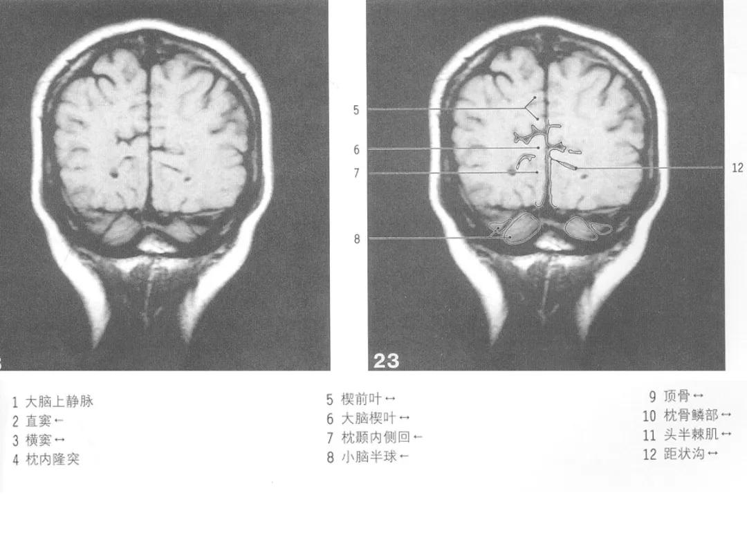 颅脑冠状状切面解剖图,颅脑mr解剖结构图