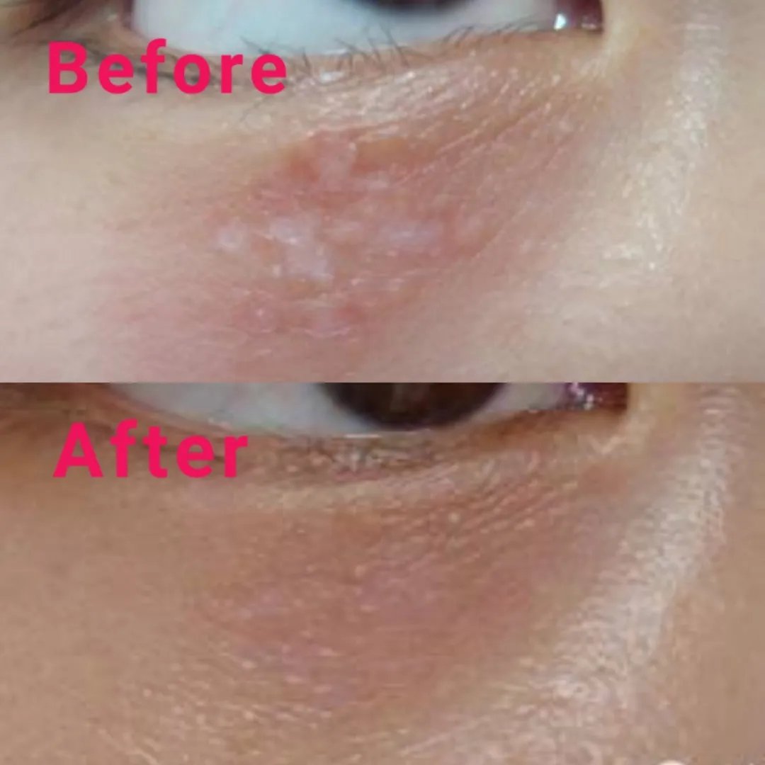 眼睛周围长特别痒小疙瘩怎么回事,女性眼睛周围长疙瘩是什么原因