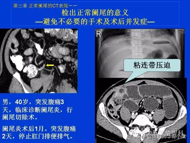 阑尾炎课件,阑尾炎的超声课件