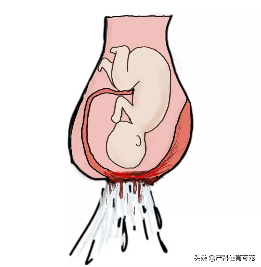 产科出血常见原因,产科医生生产前出血