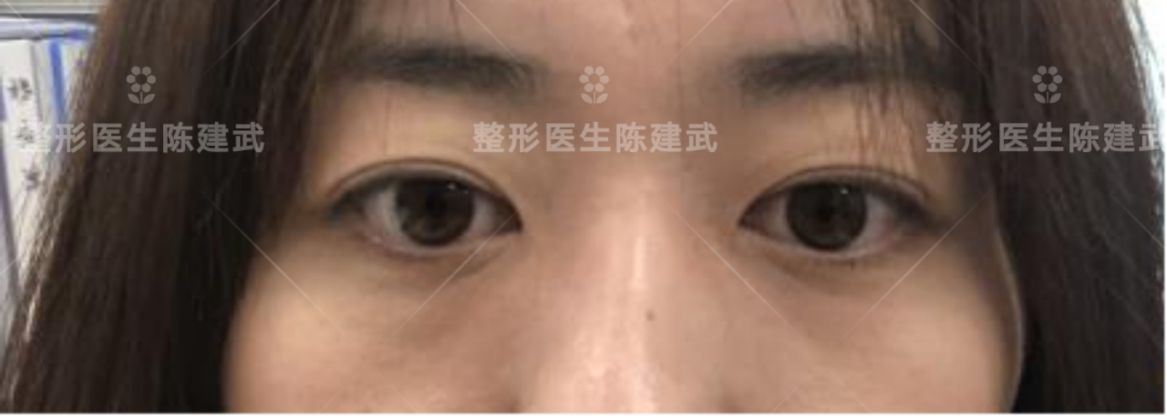 做眶隔释放眼袋后出现印第安纹,去眼袋出现印第安纹