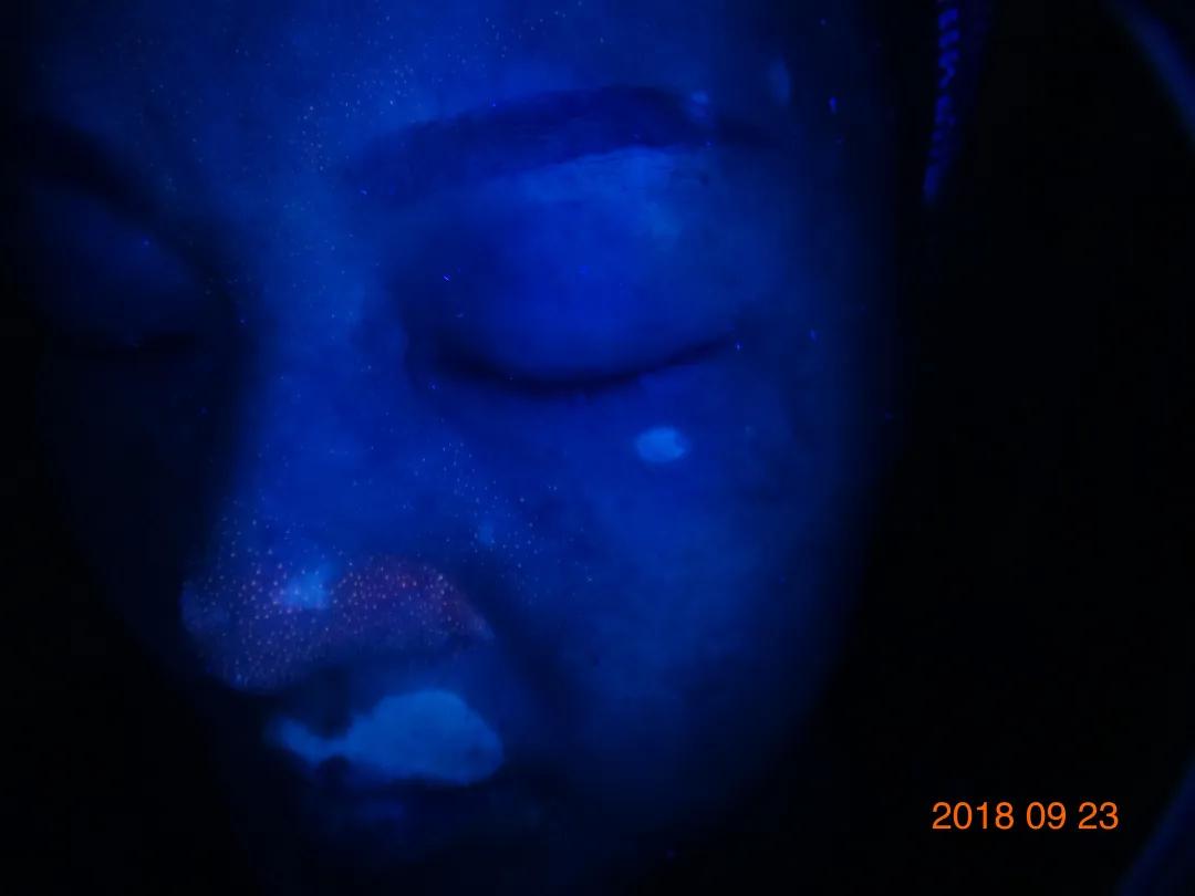 白癜风治愈一百例,白癜风治愈患者分享痊愈经验