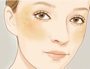 脸上长暗斑怎么办如何快速祛斑,黑褐斑雀斑用什么护肤品