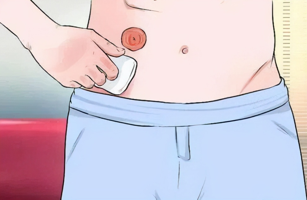 腹部人工造口,腹壁人工造瘘后生活方便吗