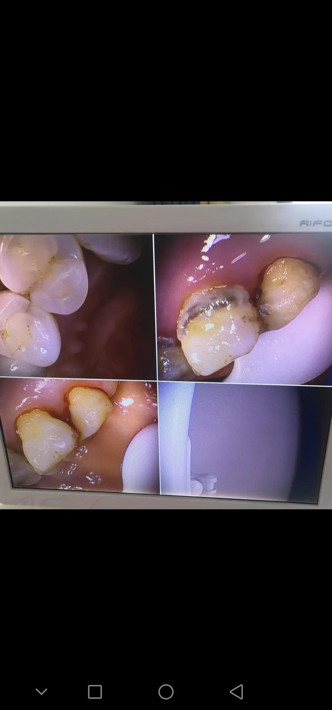 口腔卫生保健讲座第三讲牙菌斑及牙结石