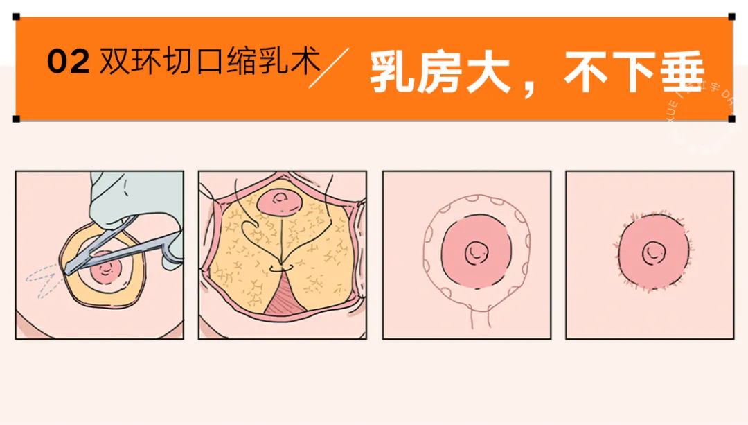 乳房缩小常见术式,乳房缩小术解除乳房过大的烦恼