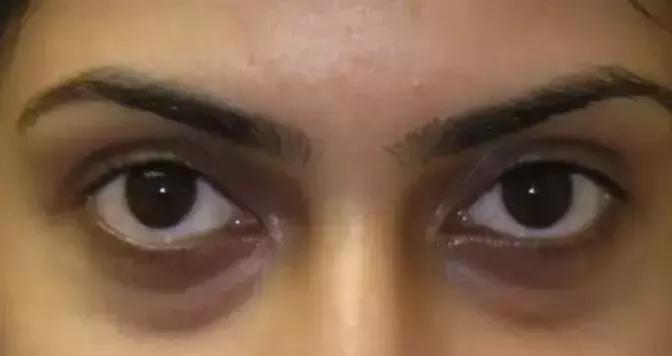 改善眼袋仅980元不开刀让你更出众,消除眼袋细纹大概多少钱