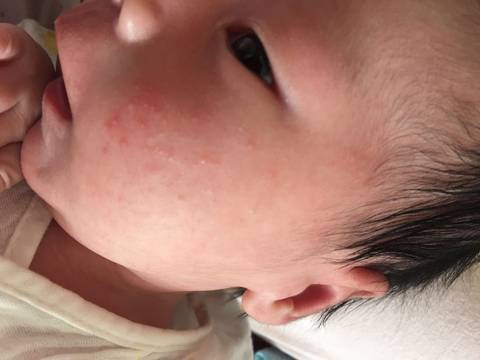 急性湿疹和亚急性湿疹,湿疹会变成干性湿疹吗