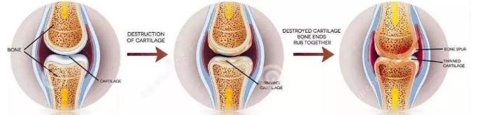 骨质增生和骨关节炎补钙有用吗,骨刺骨质增生关节炎用什么药