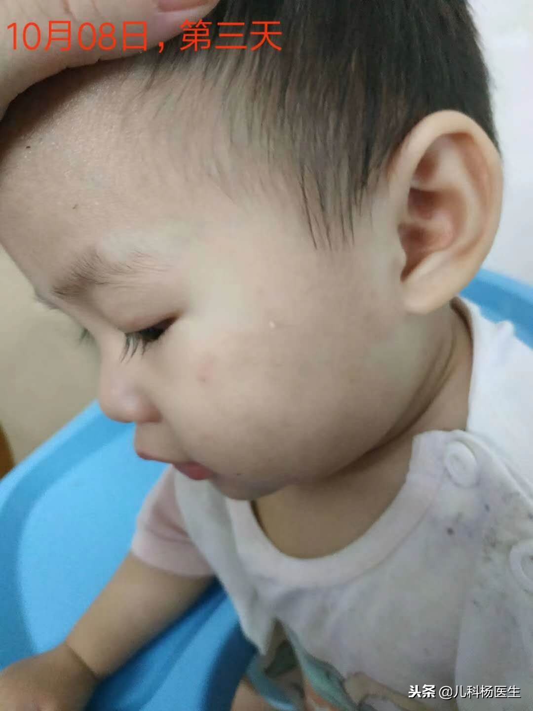 宝宝湿疹涂了炉甘石又严重了,宝宝湿疹抹了药更严重了