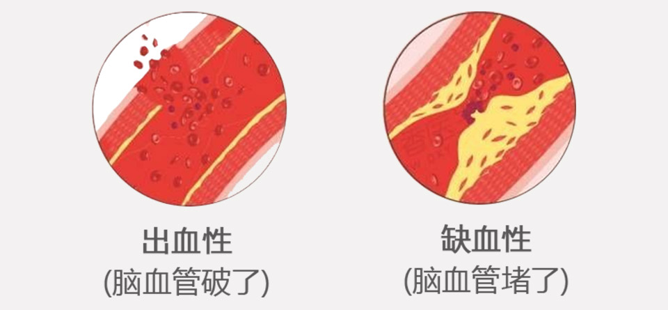 分期针刺治疗脑卒中后肢体功能障碍