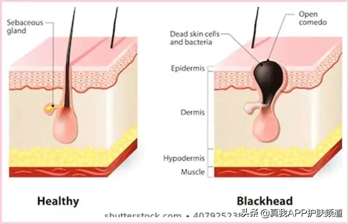 毛孔粗大黑头多简单四步轻松搞定,毛孔粗大有黑头适合用什么洗面奶