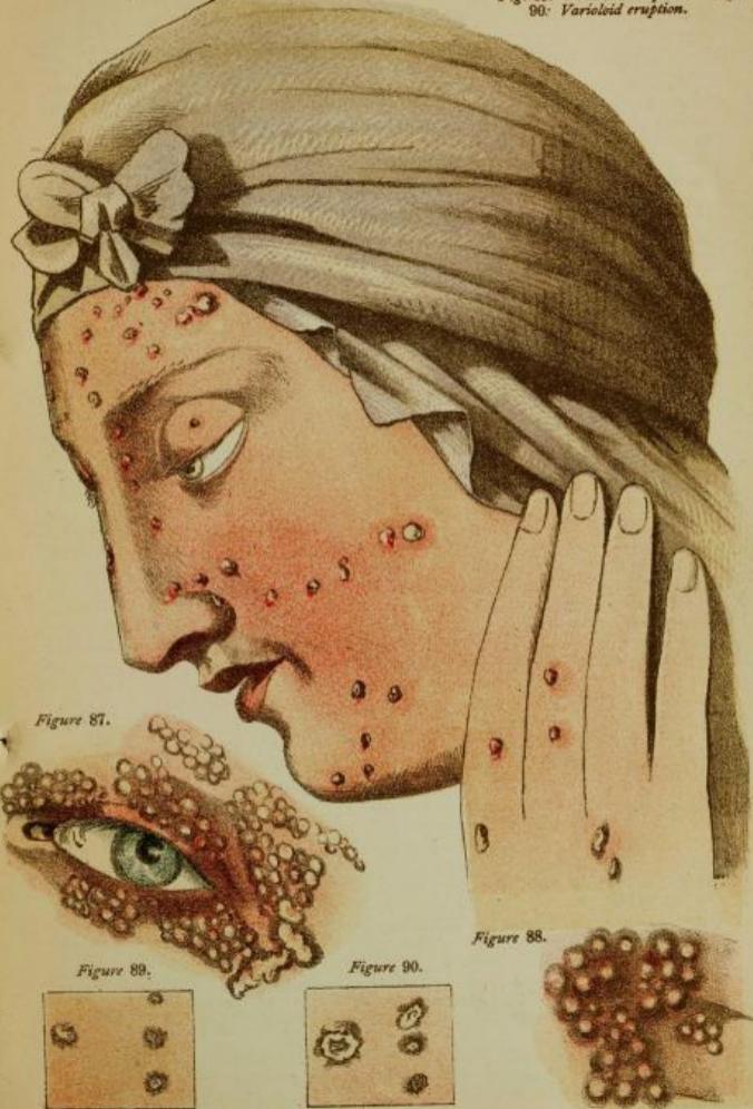 消灭天花最好的方法,消灭天花病