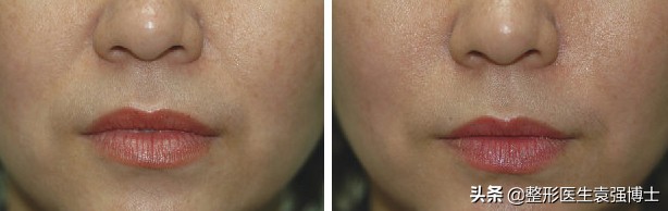 一招教你解决法令纹,这3种方法解决法令纹效果很惊艳