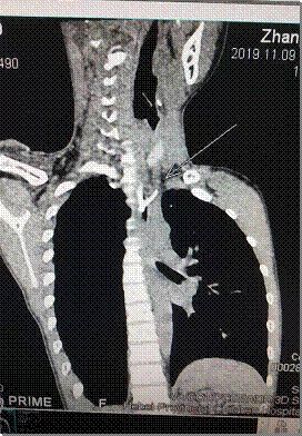 石家庄12岁男孩吃烧鸡后，咽疼、前胸疼痛！医生：这种病，可发生在任何年龄