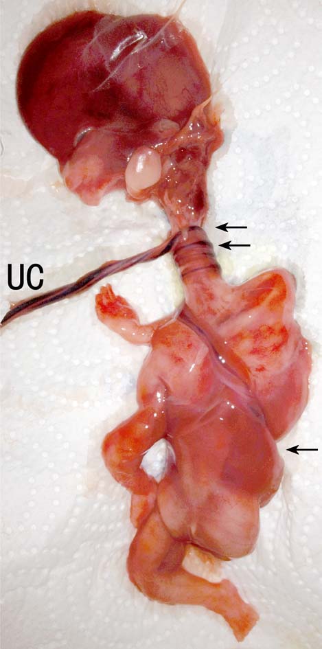 脐带超声表现,超声如何判断脐带绕颈几周