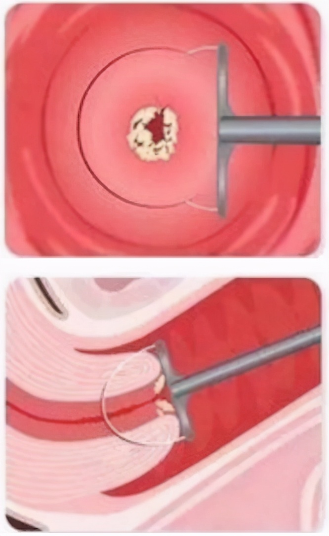 hpv持续感染3年多了不转阴怎么办,hpv高危52阳性持续2年未转阴