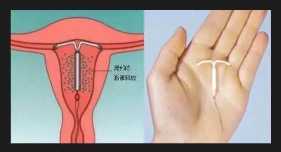 子宫腺肌症临床诊疗指南,子宫腺肌症治愈的病例