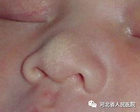 盘点新生儿特有的体征“符号”