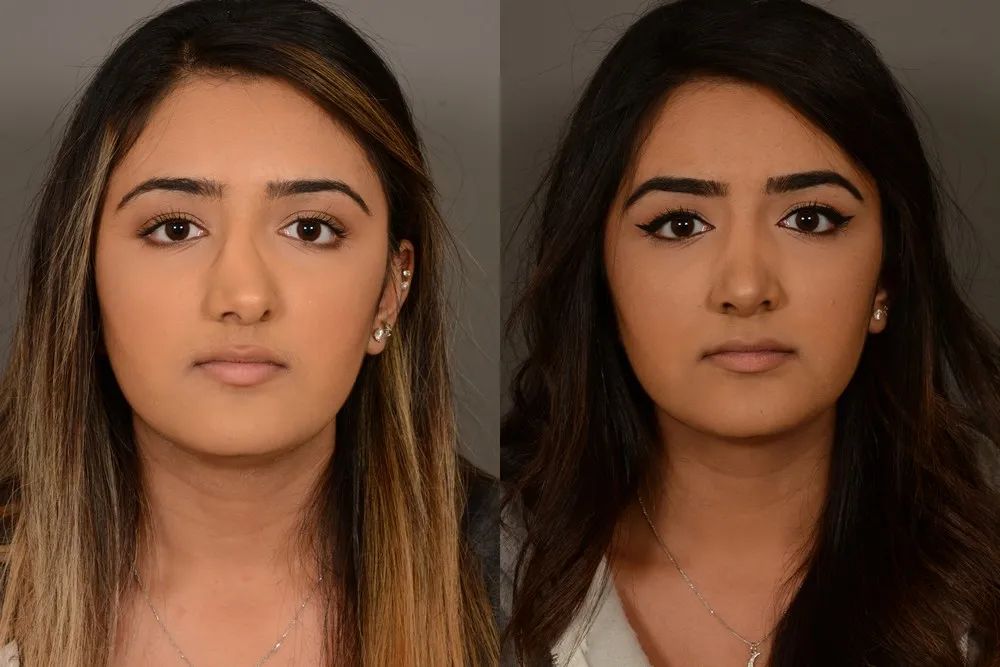 空鼻症痛不欲生,空鼻症医闹