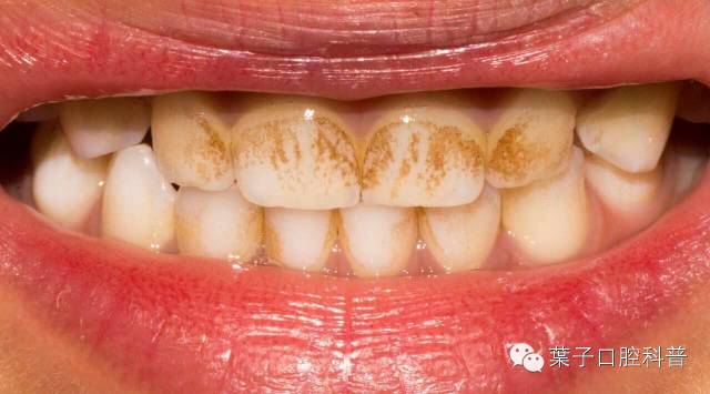 孩子牙菌斑怎么清除,孩子牙菌斑