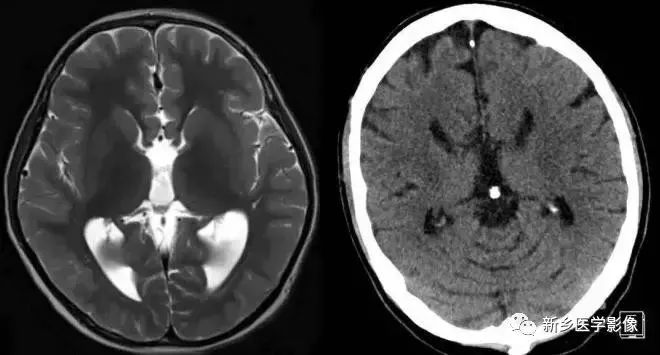 脑室影像学表现,脑室占位影像