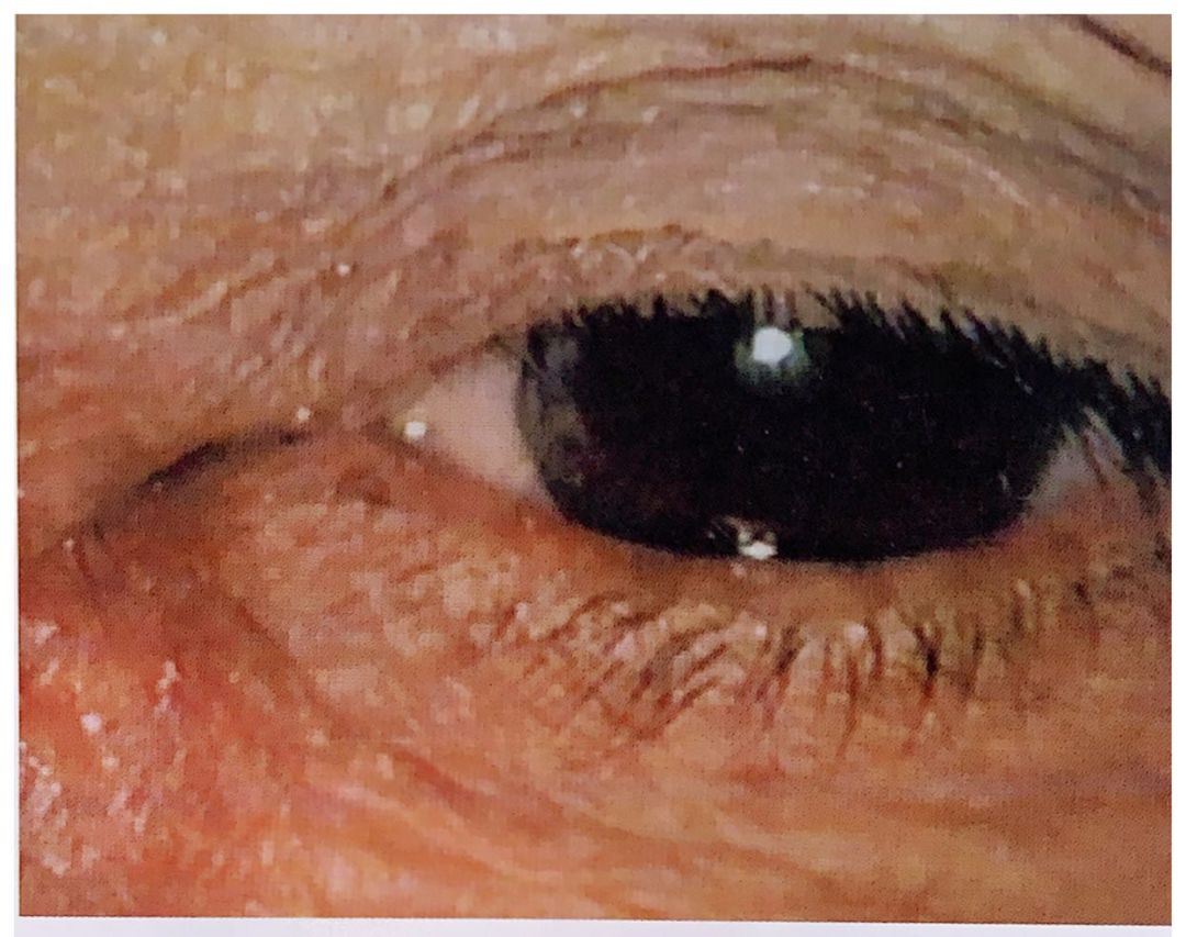 慢性泪囊炎最有效的治疗,急性泪囊炎和慢性泪囊炎的区别