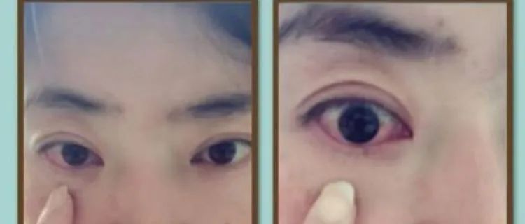 嘉兴中医院眼科结膜炎,新华医院眼科结膜炎