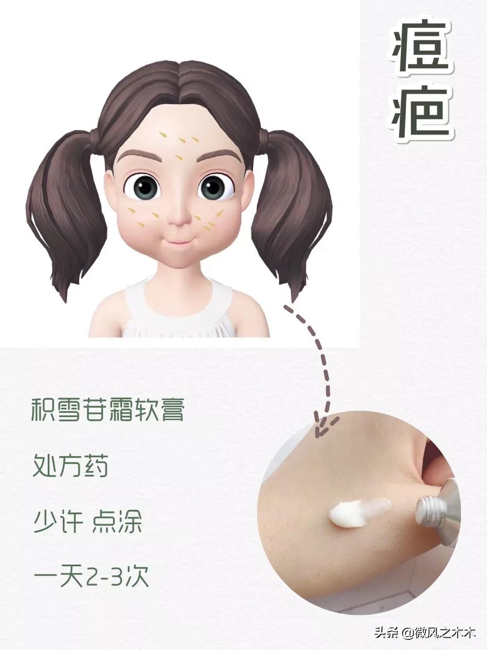 痘印痘坑消除要做多少次医美,去痘印痘坑痘疤的医美方法