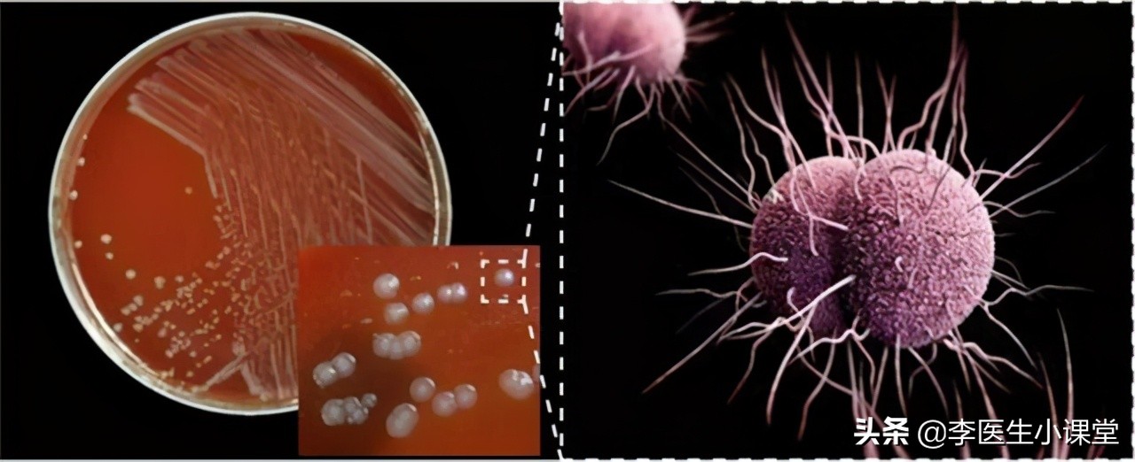 怎么预防淋病传染给家人,高锰酸钾可以预防淋病么