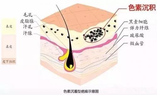 男生长青春痘怎么办才能消除,男生长了青春痘吃什么药
