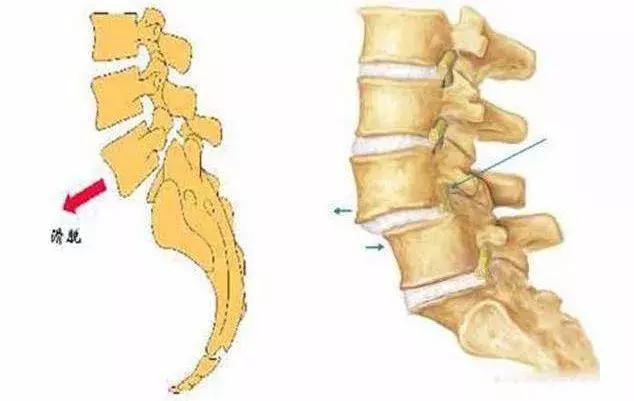 腰疼直不起来腰是什么原因引起的,青少年两侧腰疼是什么原因引起的