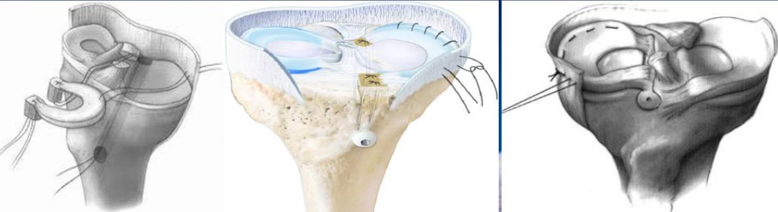 半月板损伤康复训练,半月板损伤膝盖疼的最好治疗方法