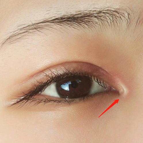 白色的凸起的疤痕增生怎么治,白色凸起疤痕是什么