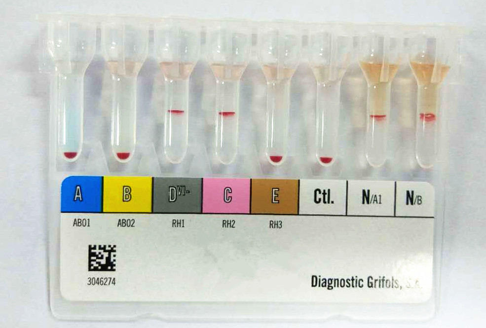 怎样检测自己是阴性还是阳性血型,血型报告单显示阳性4+