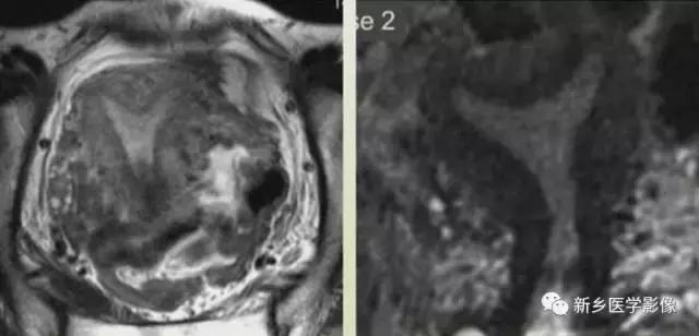 子宫发育异常，应想到的6大类常见畸形