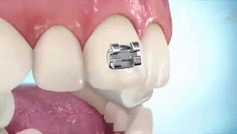 多个牙齿戴牙套矫正的全过程,部分牙齿牙套矫正的全过程